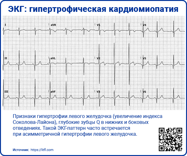 ЭКГ гипертрофическая кардиомиопатия